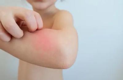 Mușcătura de căpușă la copii: Soluții de prim ajutor