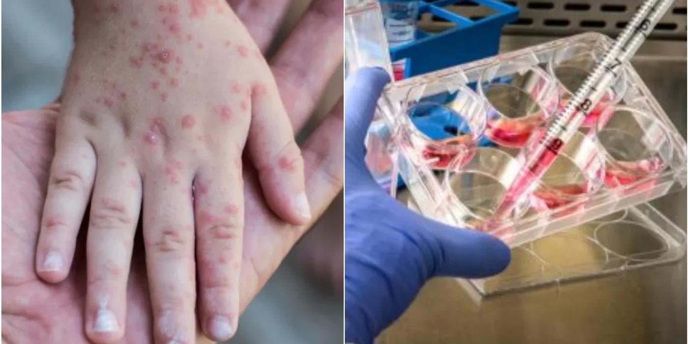 Începe o nouă pandemie? Variola maimuței, un fenomen îngrijorător la nivel mondial