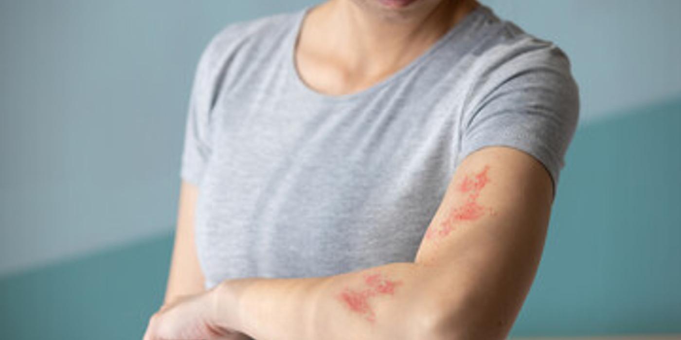 Cum calmați durerea dacă aveți zona zoster