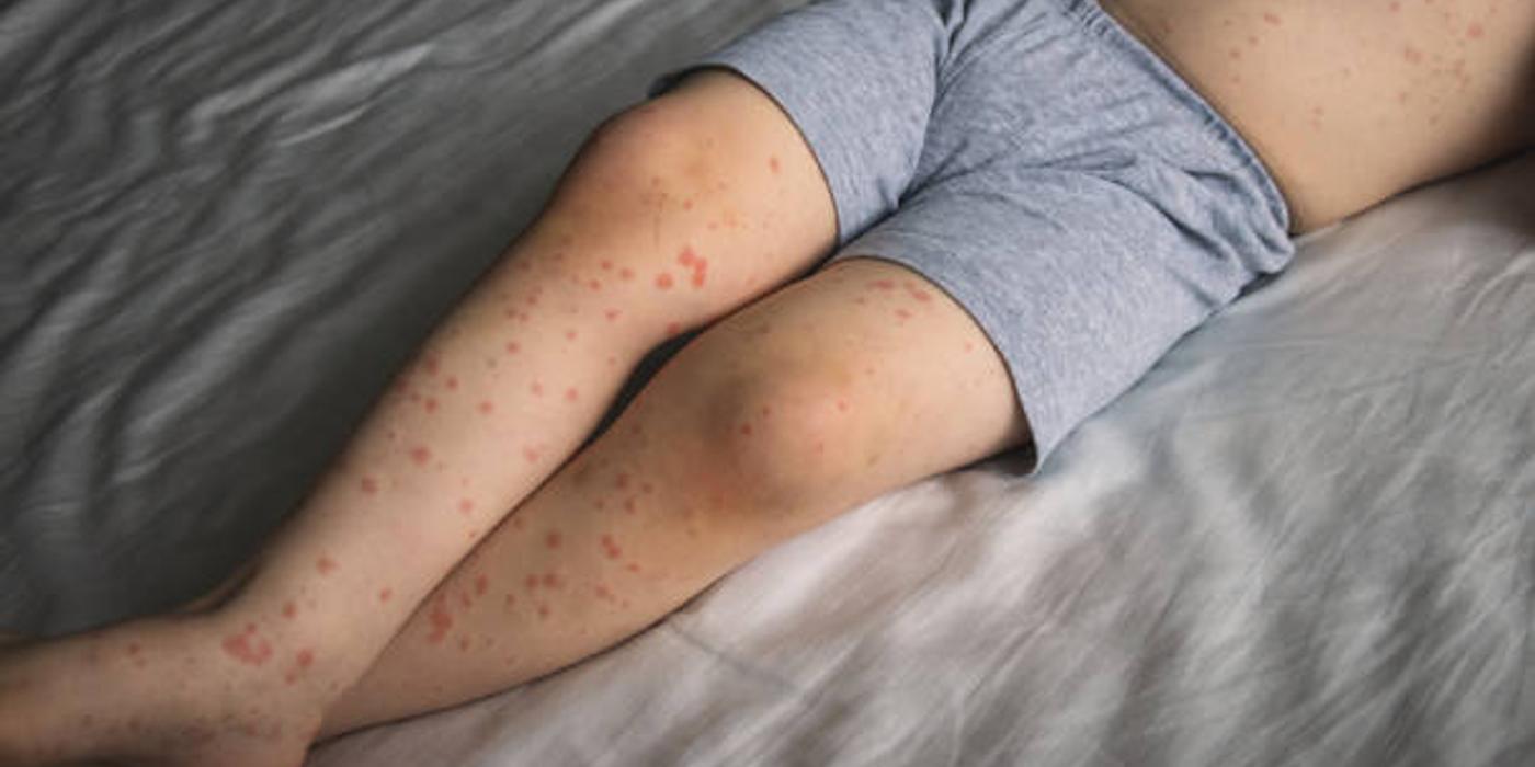 Roseola infantum: Ghid complet pentru părinți