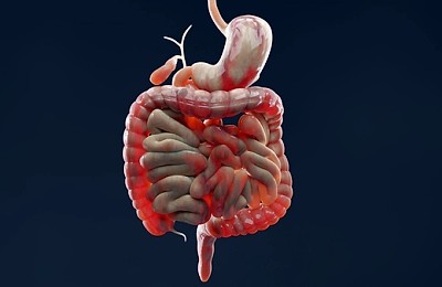 Bolile inflamatorii intestinale și rolul proctologiei în diagnostic și tratament