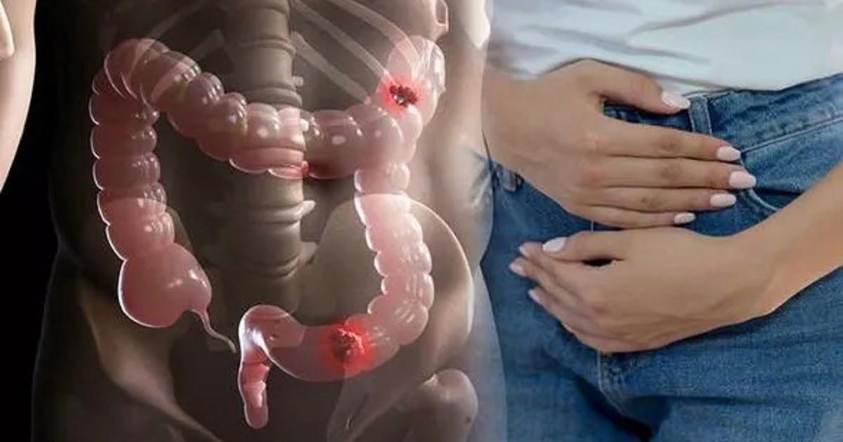 Cancerul de colon este un dușman tăcut: Patru semne la care ar trebui să fii foarte atent și care îți pot salva viața