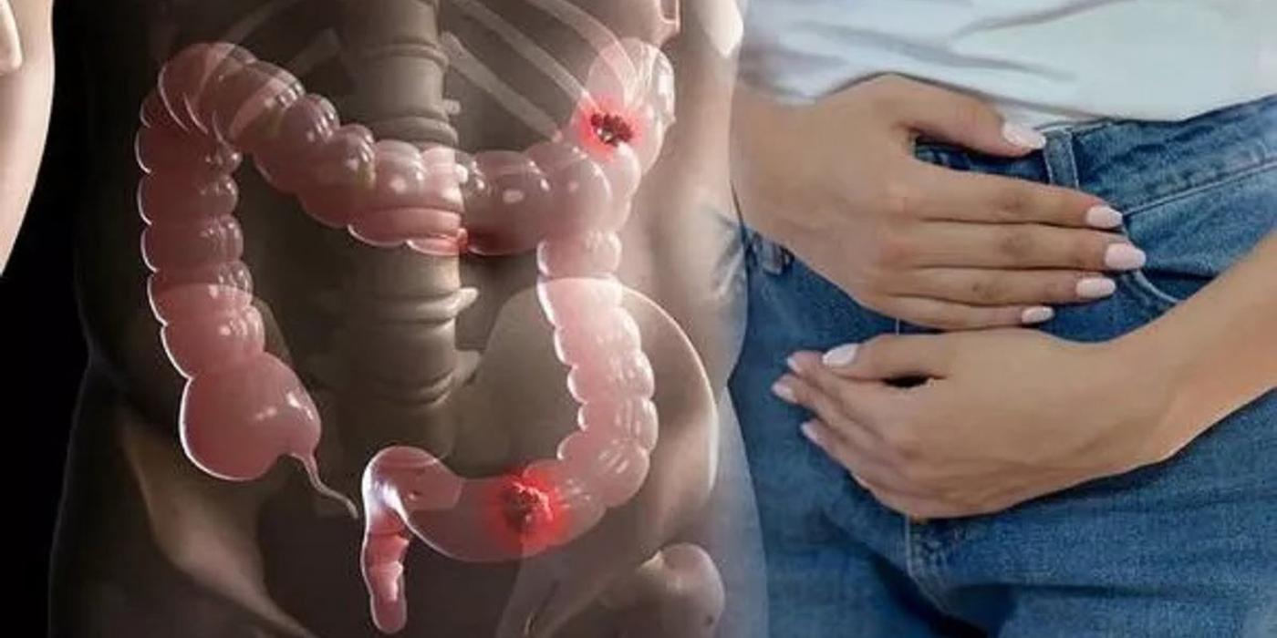 Cancerul de colon este un dușman tăcut: Patru semne la care ar trebui să fii foarte atent și care îți pot salva viața