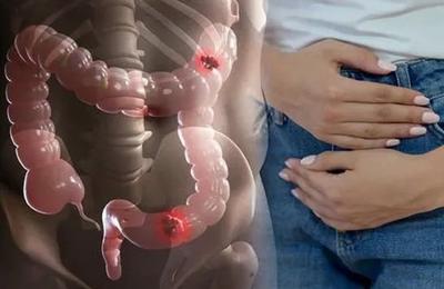 Cancerul de colon este un dușman tăcut: Patru semne la care ar trebui să fii foarte atent și care îți pot salva viața