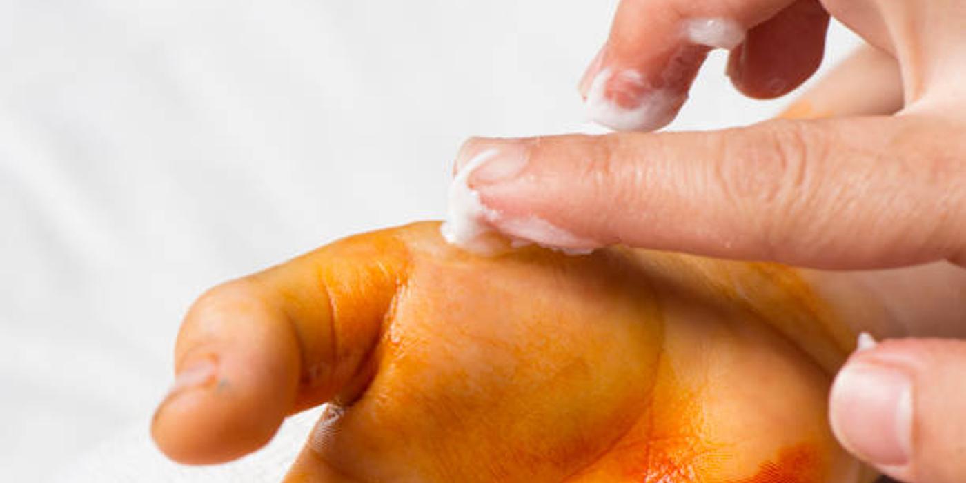 Primul ajutor la copii în caz de arsuri. Pași de urmat