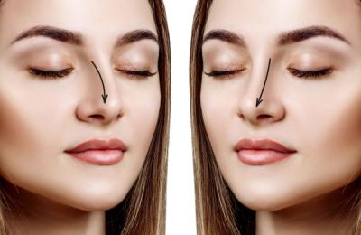 Transformare și Eleganță: Rinoplastia cu Dr. Bortolini la Clinica BePerfect din București