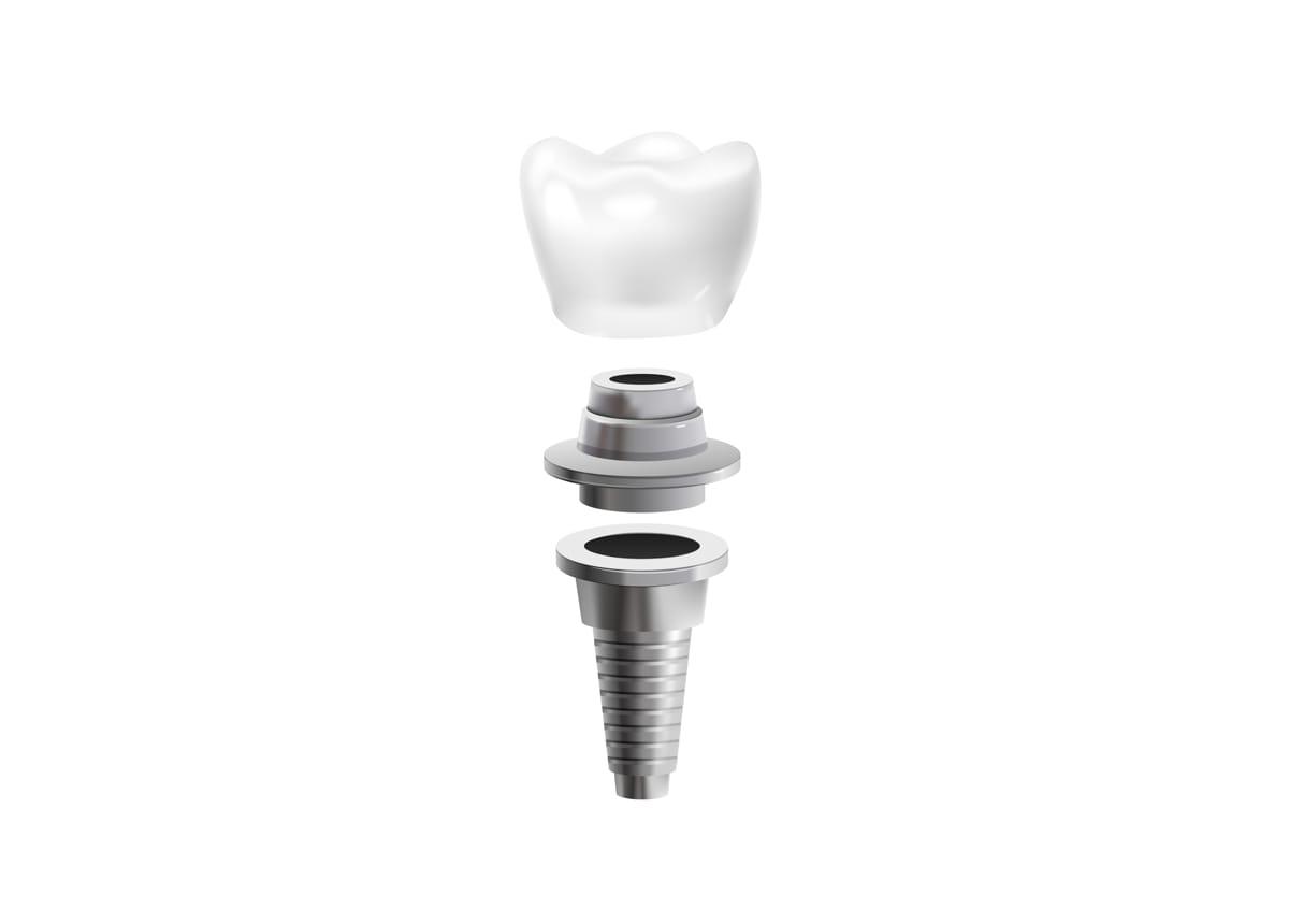 Semnele respingerii unui implant dentar