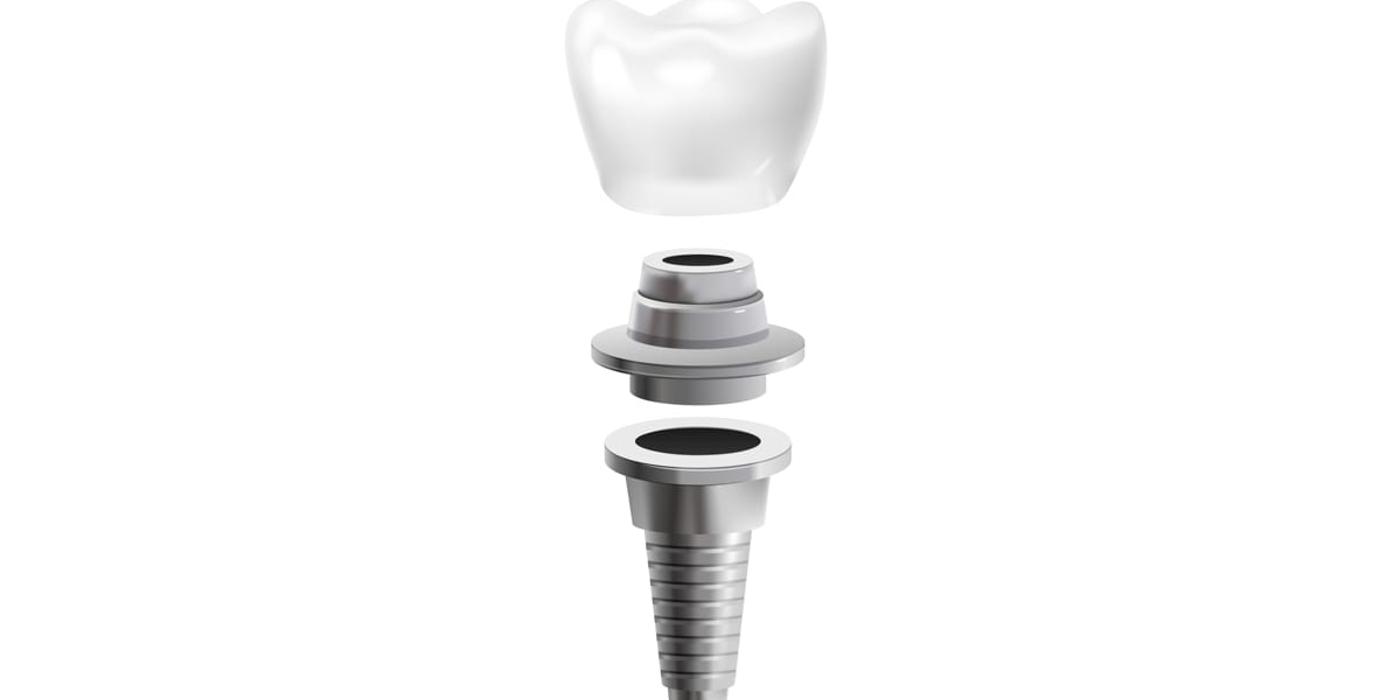 Semnele respingerii unui implant dentar