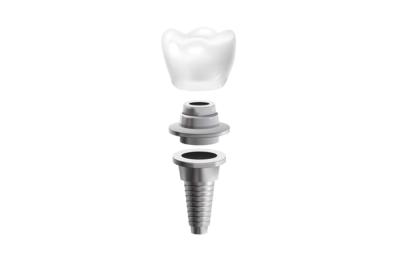 Semnele respingerii unui implant dentar
