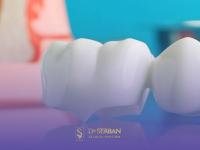 La ce prețuri ne așteptăm pentru coroane dentare în București? Clinica stomatologică Dr. Șerban