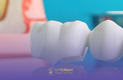 La ce prețuri ne așteptăm pentru coroane dentare în București? Clinica stomatologică Dr. Șerban
