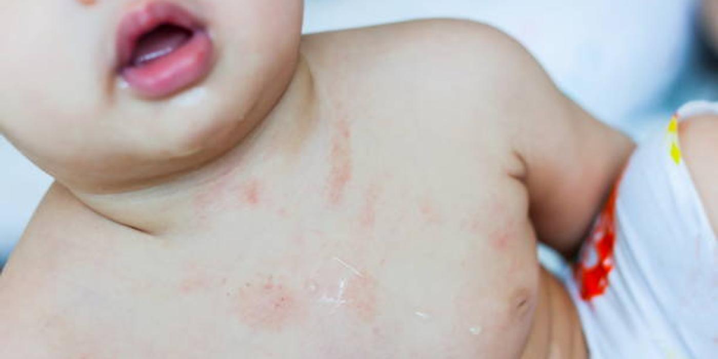 Dermatita seboreică infantilă: Ce trebuie să știi despre această afecțiune a pielii la bebeluși