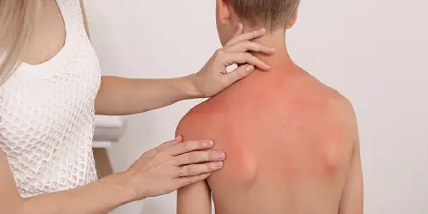 Arsuri solare la copii: primul ajutor