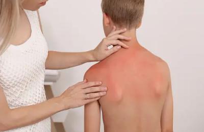 Arsuri solare la copii: primul ajutor