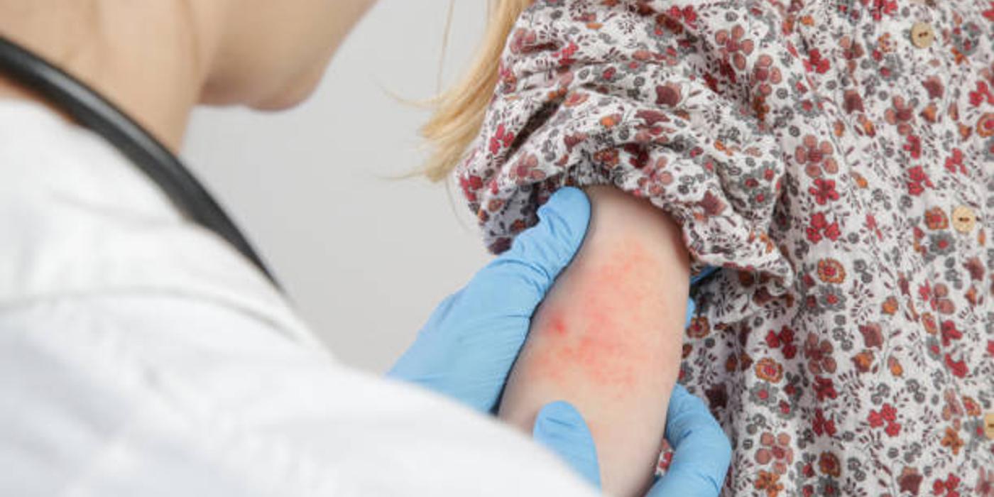 Psoriazis la copii: Tot ce trebuie să știți