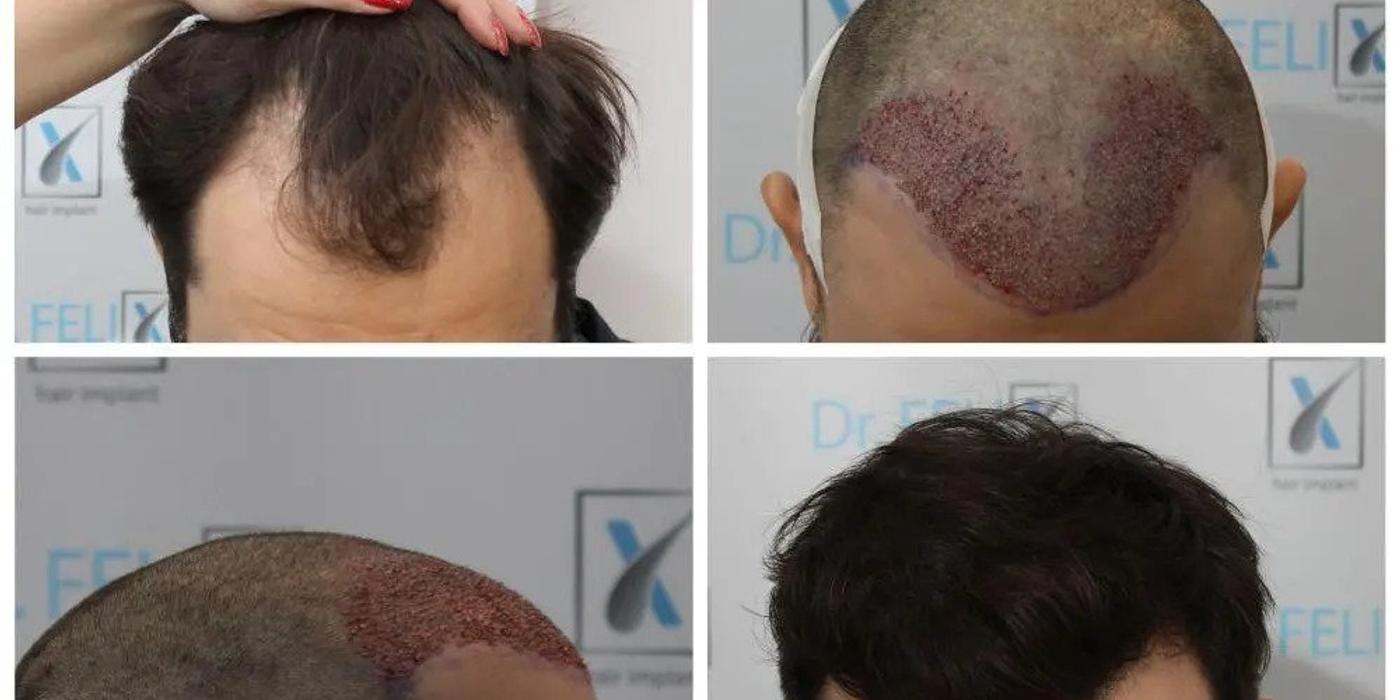 Accesează drfelixhairimplant.ro dacă te confrunți și tu cu pierderea părului!