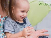 Dermatita atopică la 2 ani: când nu mai este suficientă doar îngrijirea de acasă și necesită tratament