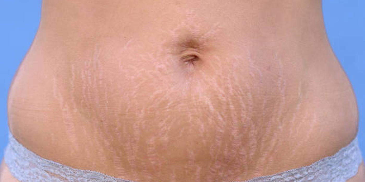 Vergeturile roșii: cauze și metode de tratament