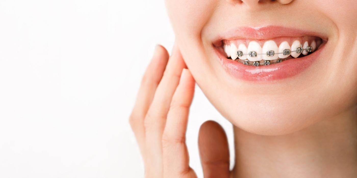 Top 5 mituri despre aparatul dentar