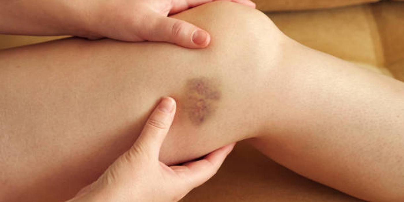 Canicula și spargerea vaselor de sânge