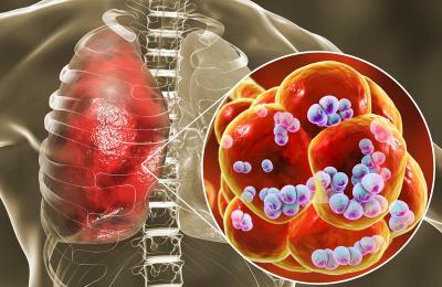 Epidemia gravă care a lovit grav un oraș din România. 3 pacienți au murit, alți 120 sunt internați