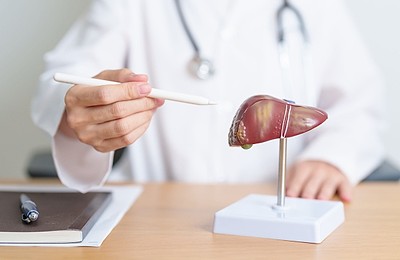 Cancerul de ficat (hepatic): Ce este, cauze, simptome și opțiuni de tratament