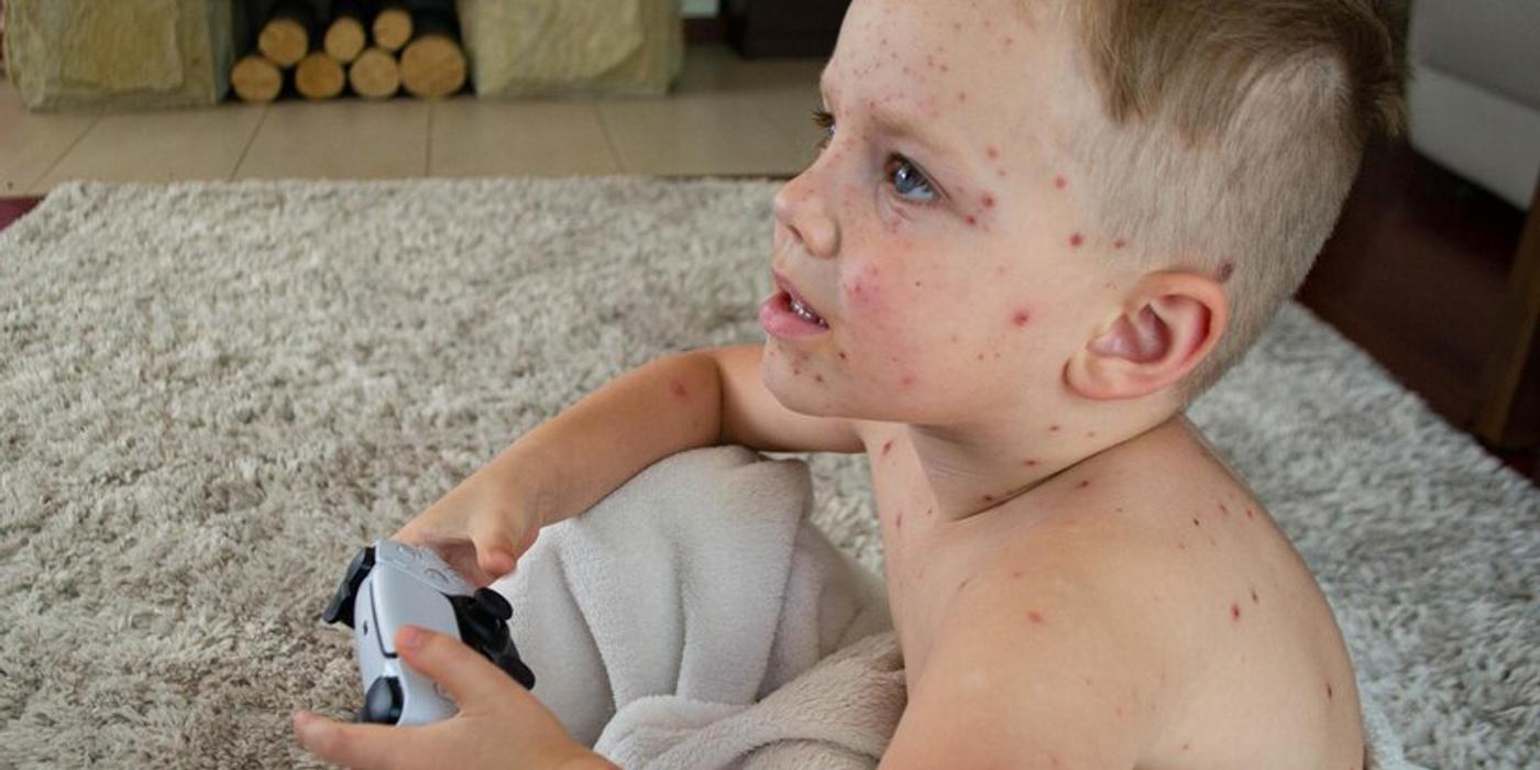 Boli contagioase comune la copii pe care părinții ar trebui să le cunoască