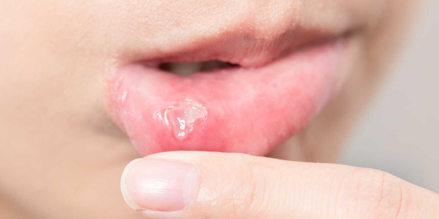 Cele mai frecvente infecții bucale la adulți și copii: cauze, simptome și tratament