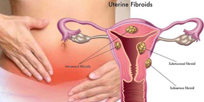 Ce simptome dă fibromul uterin și cum poate fi eliminat în jumătate de oră, fără operație