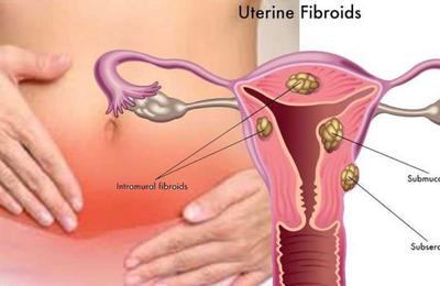 Ce simptome dă fibromul uterin și cum poate fi eliminat în jumătate de oră, fără operație