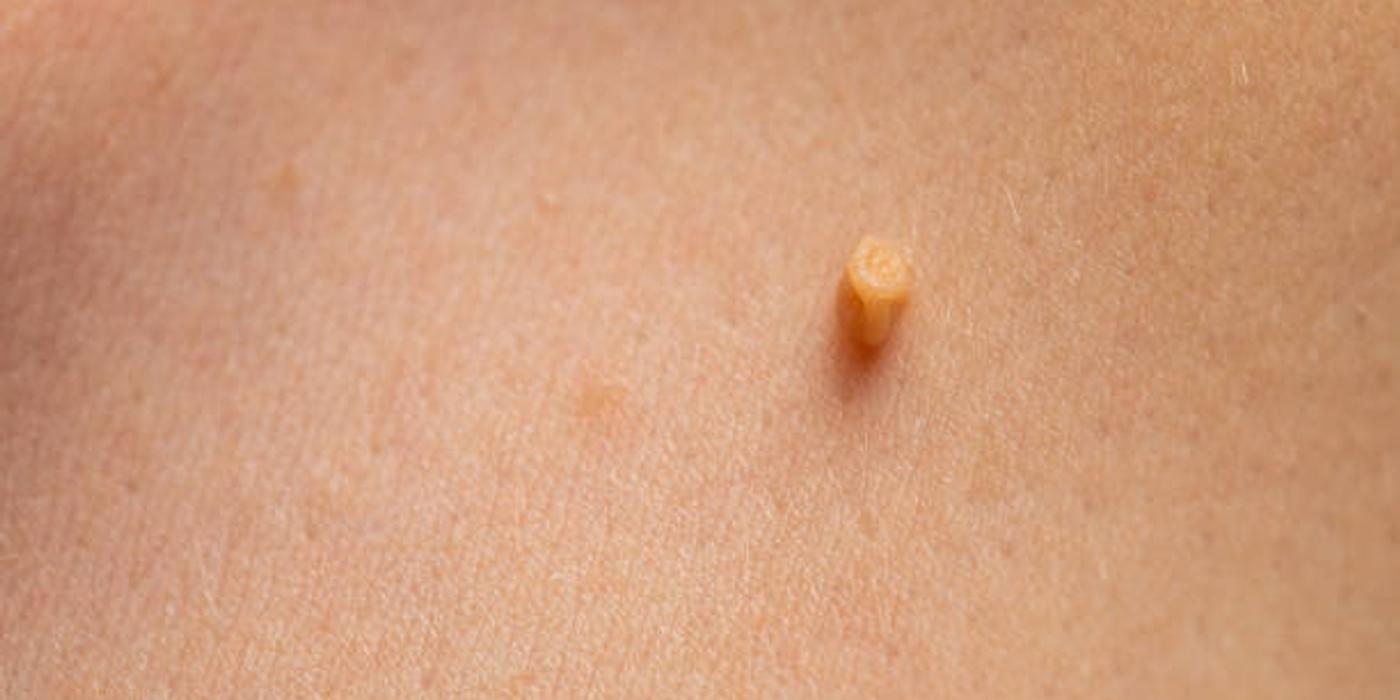 Papiloamele: ce sunt, cauze și soluții naturale de îndepărtare a lor