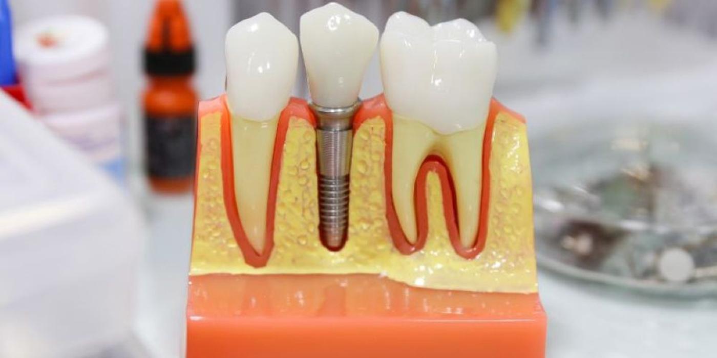 Mituri despre implantul dentar: durere, respingere, durabilitate și recuperare