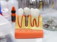 Mituri despre implantul dentar: durere, respingere, durabilitate și recuperare