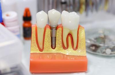 Mituri despre implantul dentar: durere, respingere, durabilitate și recuperare