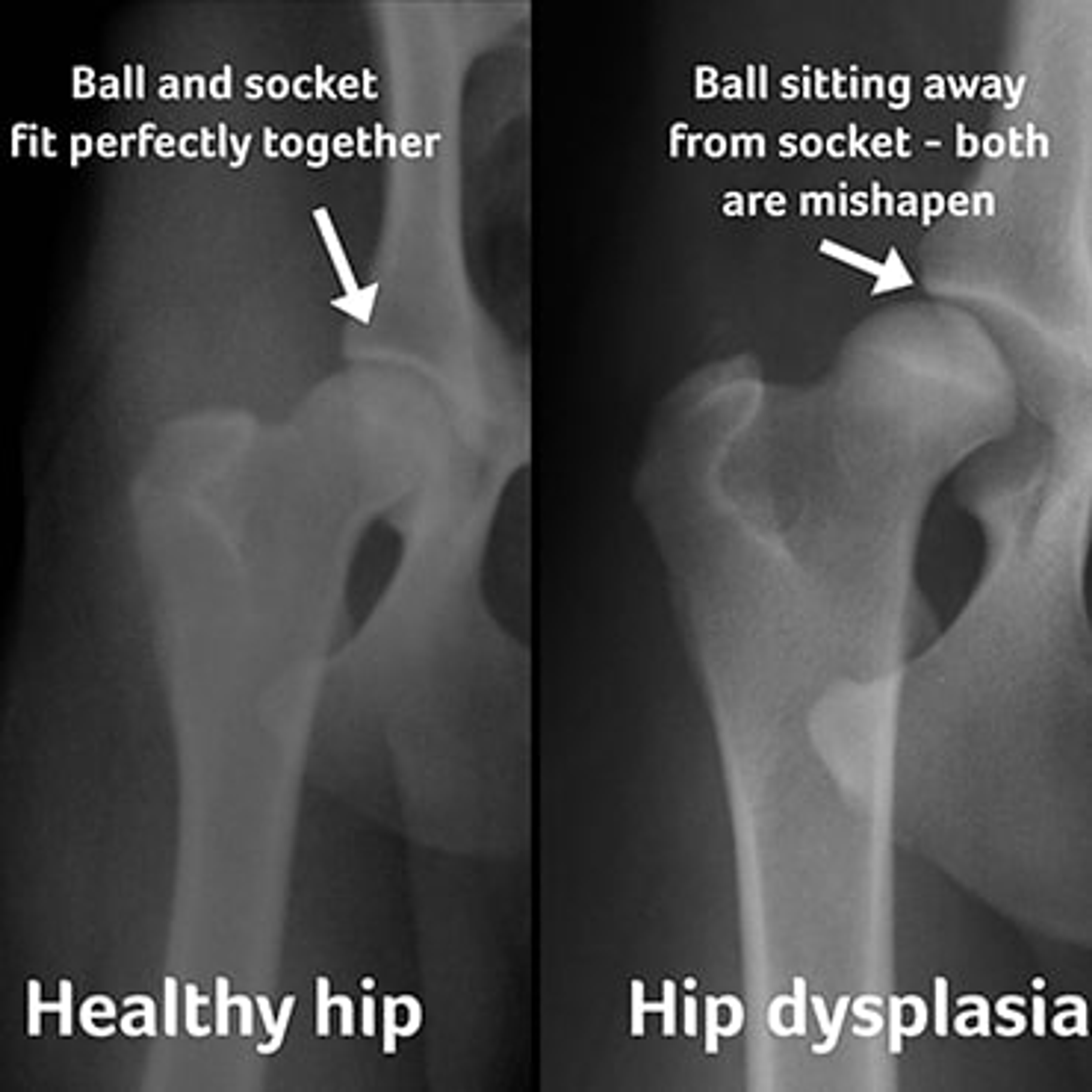 Hip dysplasia 