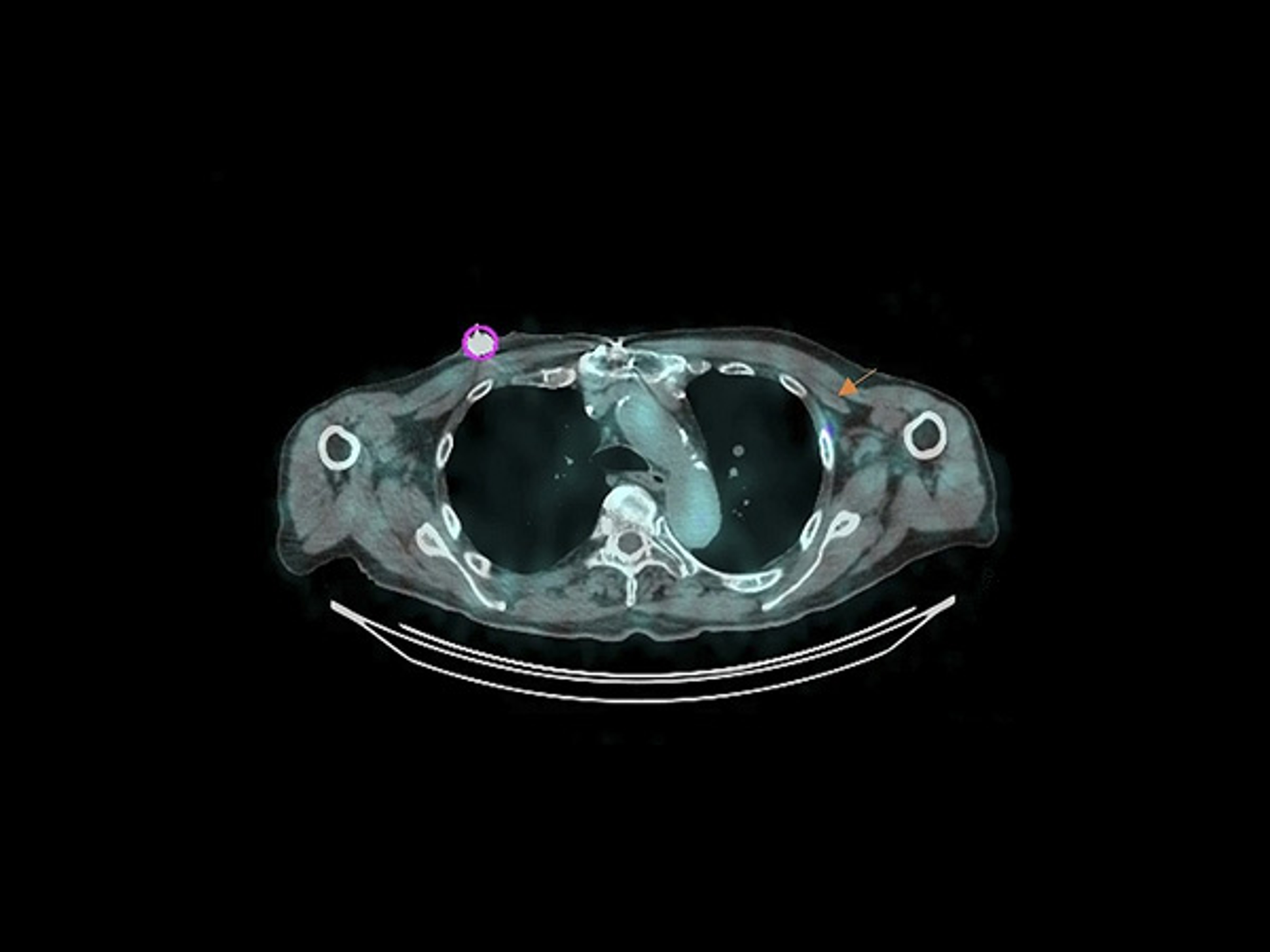 Feasibility and safety of [¹⁷⁷Lu]Lu-PSMA-617 administration via TIVAP confirmed