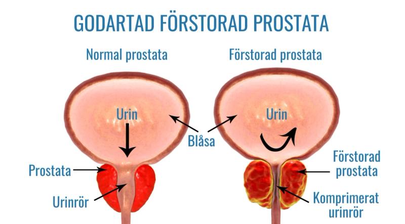 Urineringsproblem visas genom en illustration där den förstorade prostatan trycker på urinröret och förhindrar urinflödet från urinblåsan.