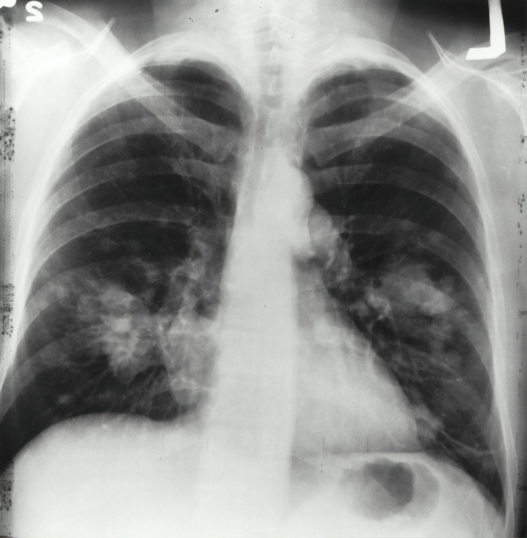 An X-ray image of a human chest showing the lungs and heart. The image reveals areas of opacity, indicating potential medical concerns such as infections or tumors.