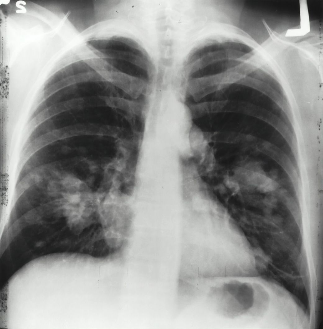 An X-ray image of a human chest showing the lungs and heart. The image reveals areas of opacity, indicating potential medical concerns such as infections or tumors. — Credit: Photo by National Cancer Institute on Unsplash