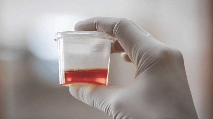 Featured image for: Blood in Urine: Causes, Symptoms, and When to See a Doctor