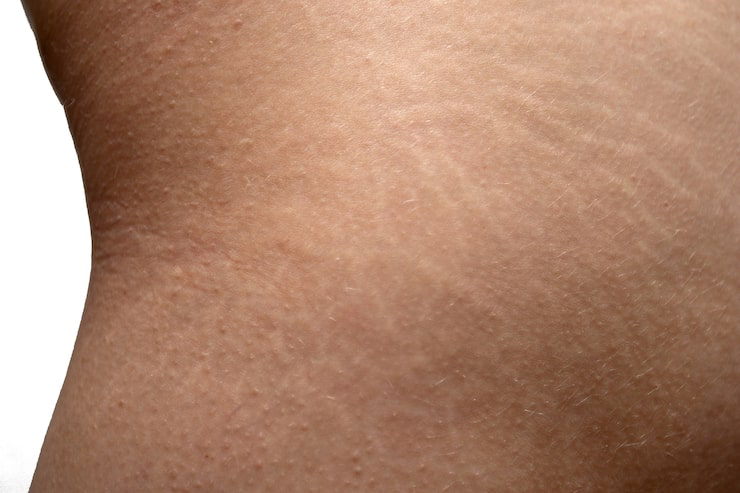 Stretch-Marks