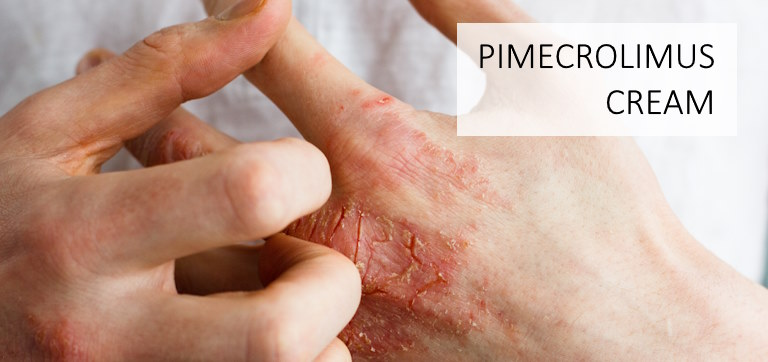 finger-burn-blister