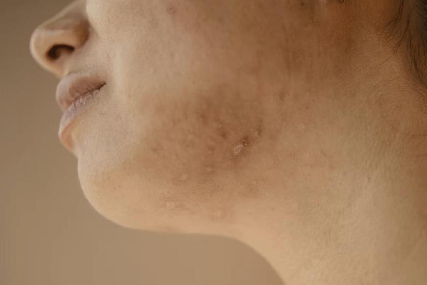 Featured image for: How Do Pimple Patches Work? Benefits & Best Buys
