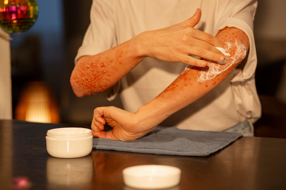 Featured image for: Treating Ringworm: Fast Relief for Skin Infections