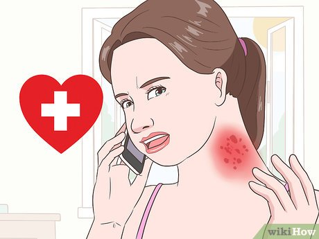 Explaining when to use the Nystatin Cream