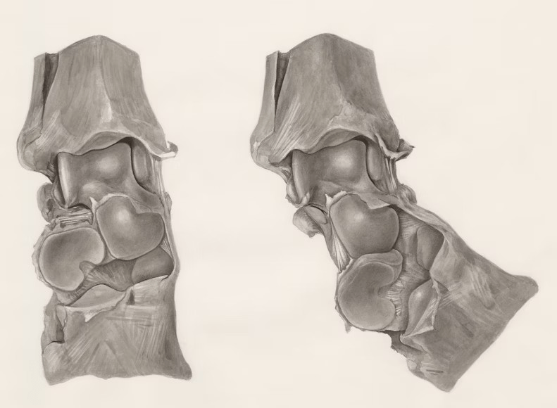 Examples of knee braces