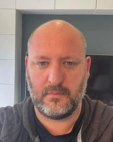 Hair transplant — Before