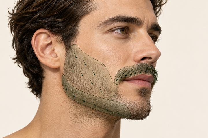 Beard regions and natural hair directions considered in transplant design