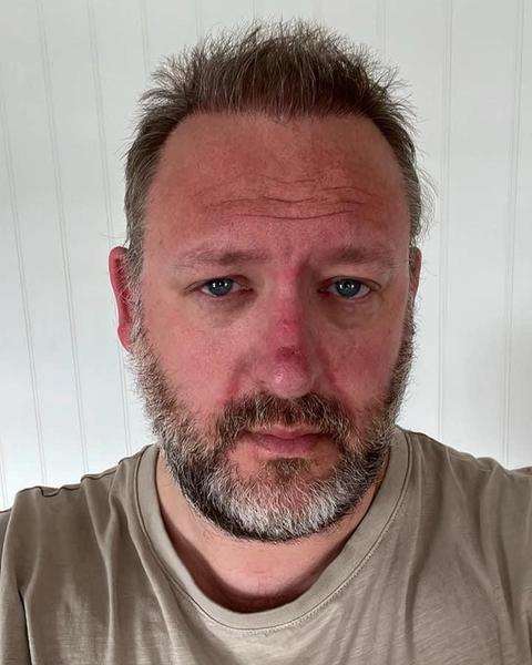 Hair transplant — ROOSTERED