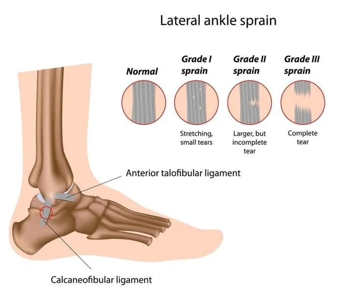 Diagrama de esguince de tobillo lateral, mostrando grados de lesión y ligamentos afectados.